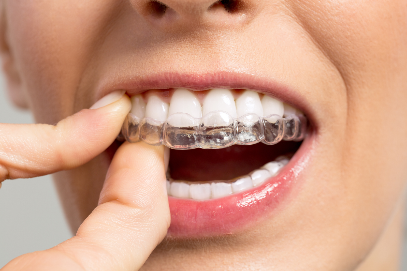 Confused About Teeth Alignment? Here’s Why Invisible Braces in Ahmedabad Are Trending
